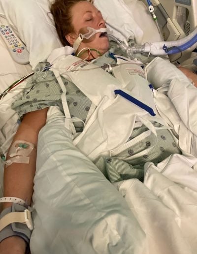 Stephanie Hudson intubated and in a coma in the ICU with ice packs covering her body.